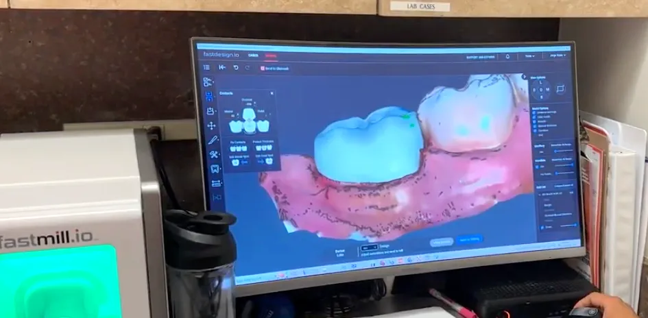 Implant Supported Bridges