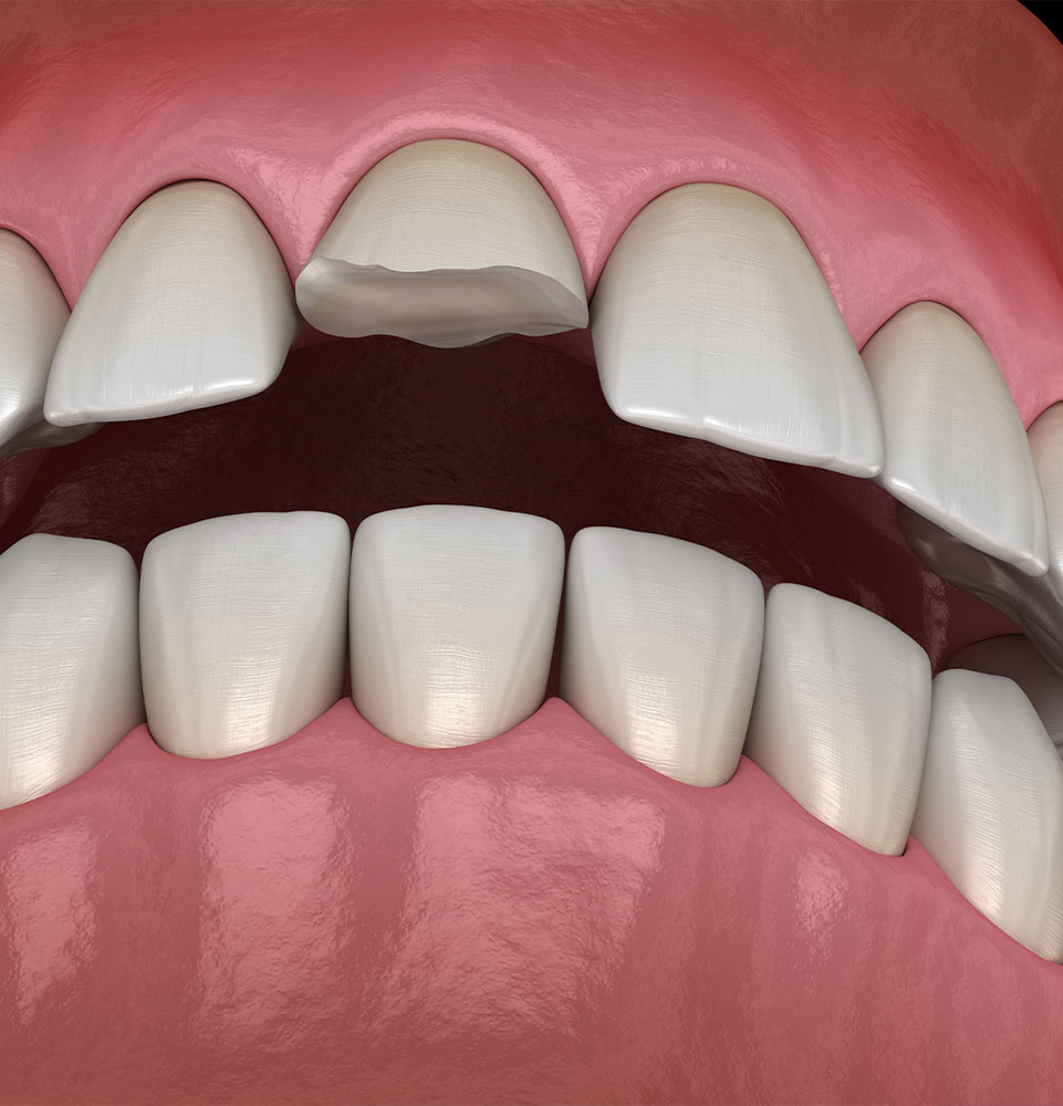 illustration of cracked teeth