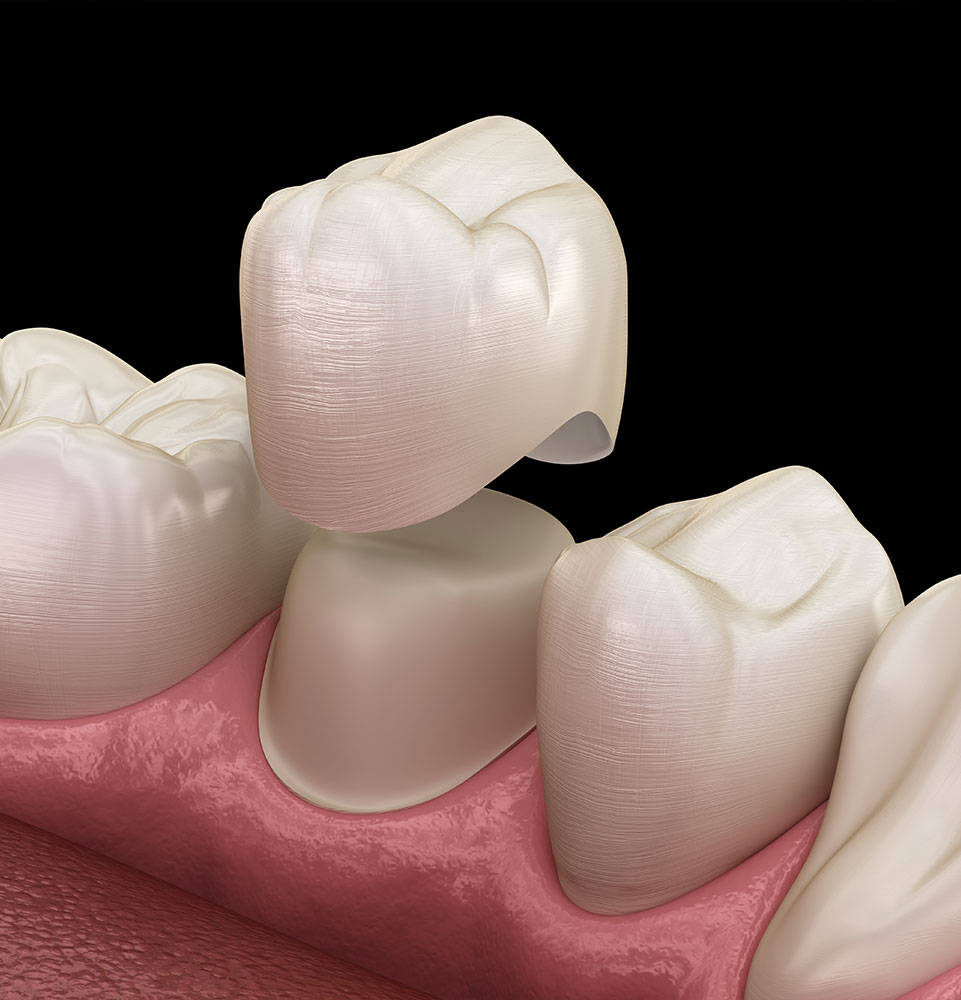 illustration of dental crown