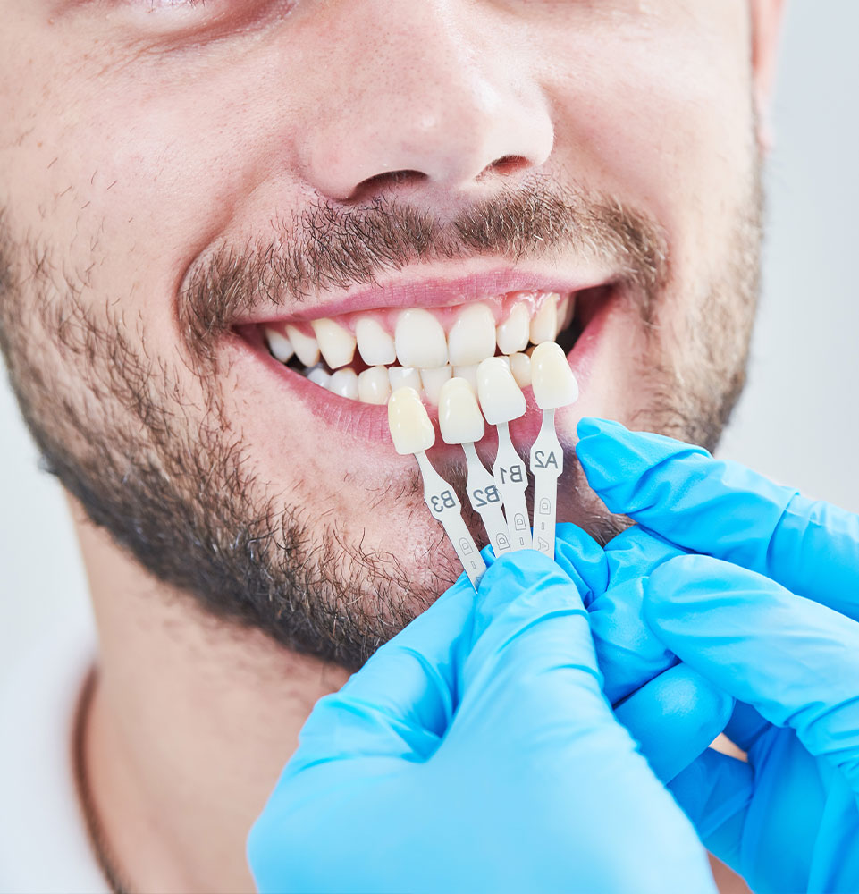 Veneers Treatment