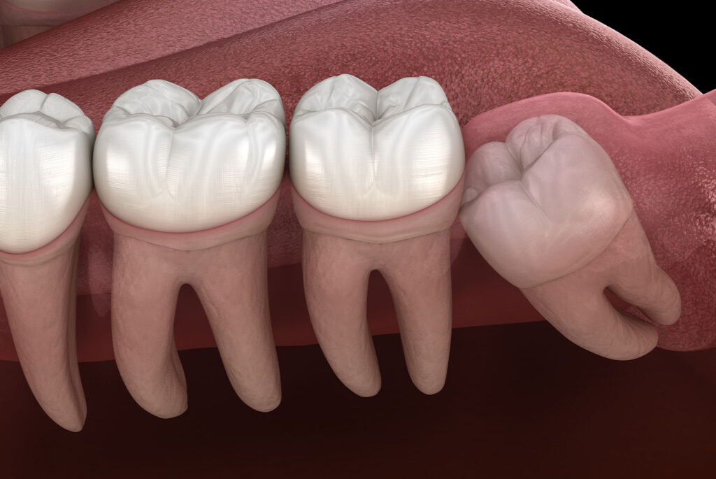 Wisdom tooth with impaction at molar tooth. Medically accurate tooth 3D illustration