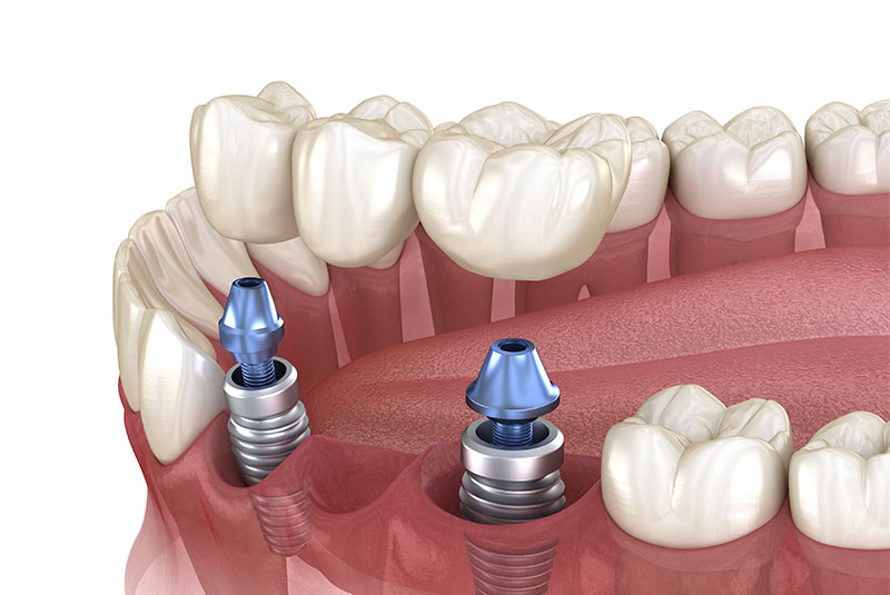 dental implant bridge model