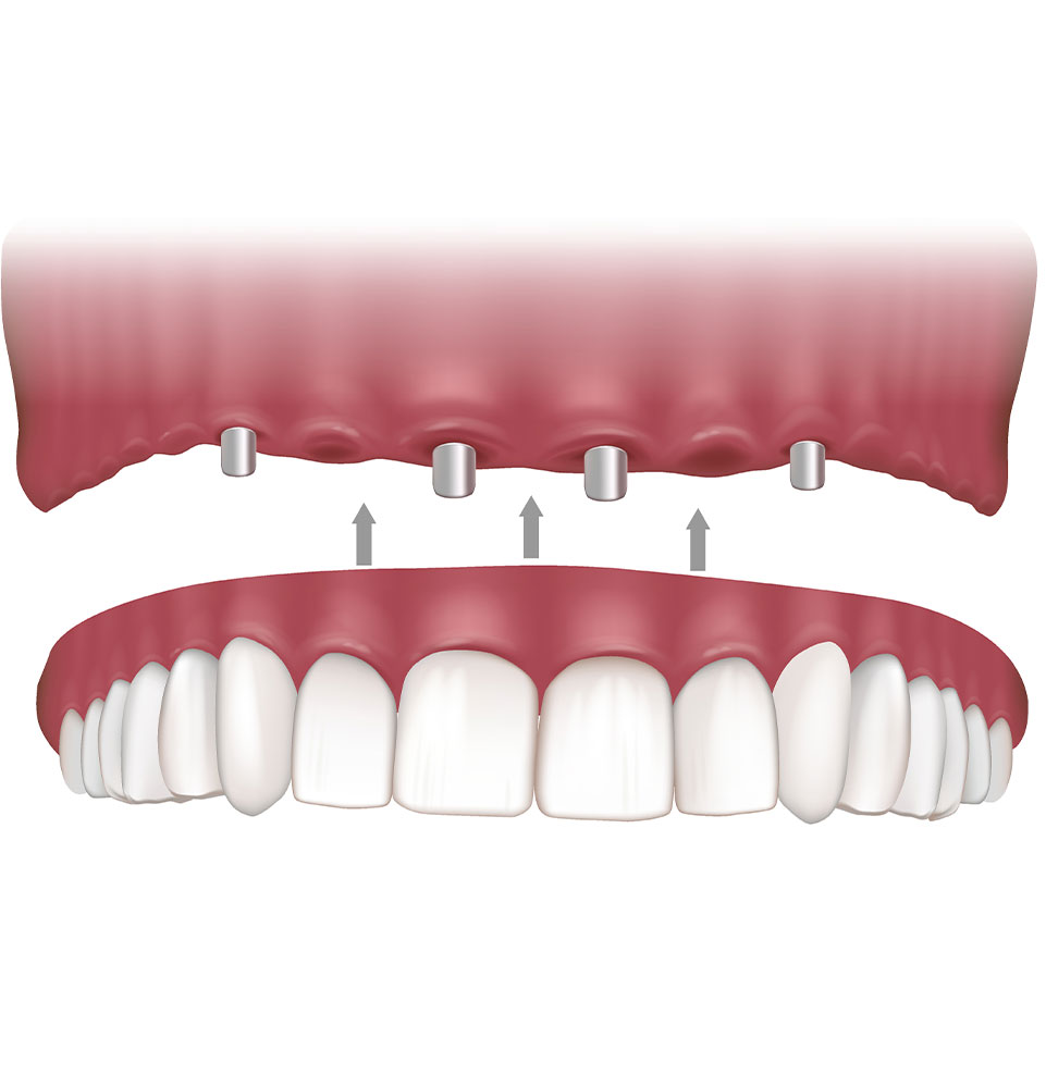 Overdentures - Implant Model